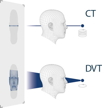 Bild zur Veranschaulichung der 3D Diagnostik. Strahlenbündel konisch anstatt einzeilig wie bei CT.